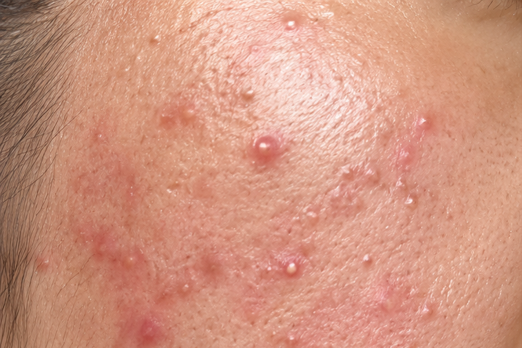 Acne Control