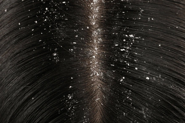 Anti Dandruff