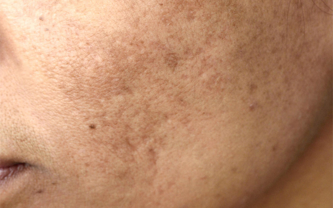 Pigmentation